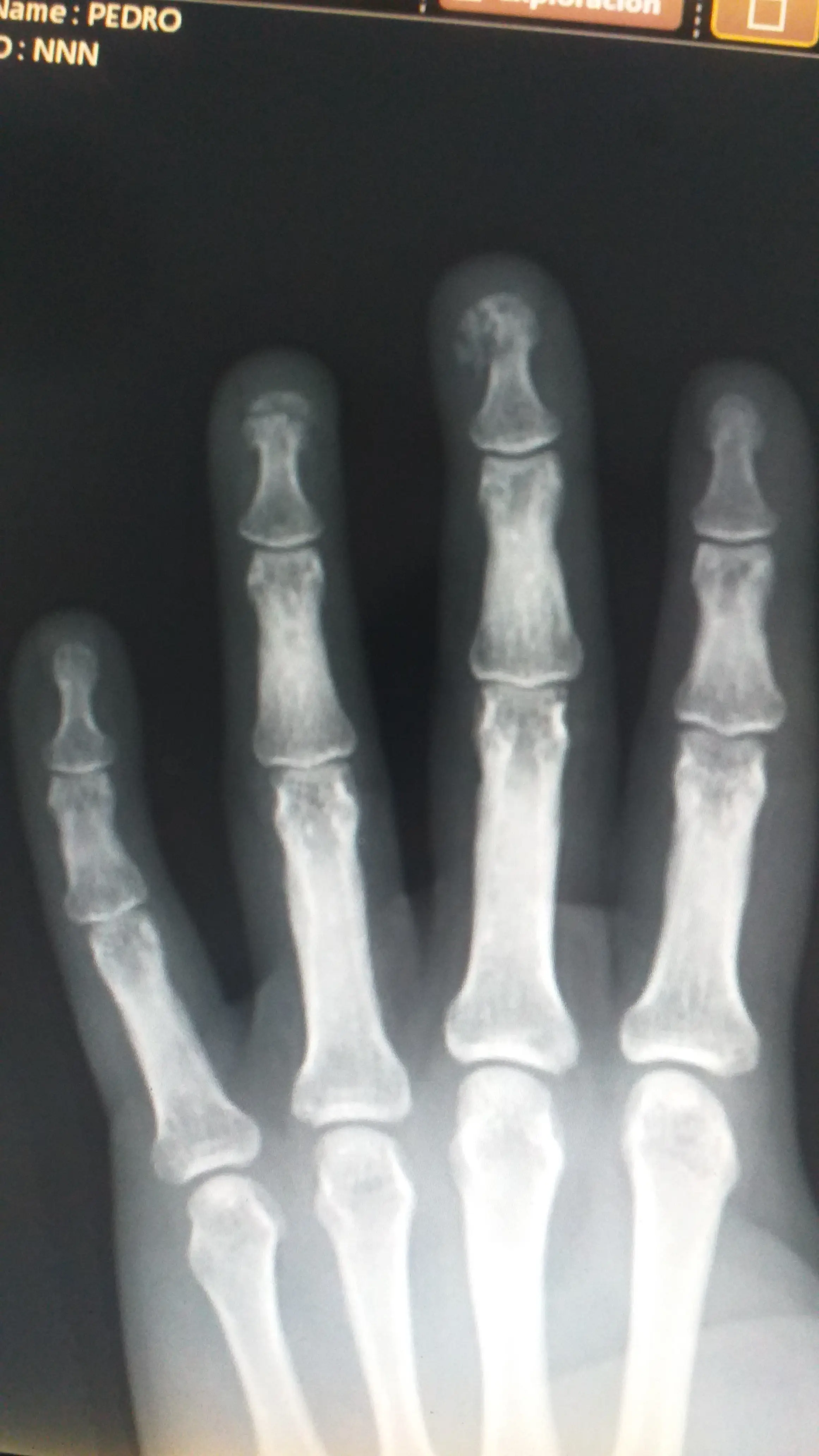 Raio-x da mão com lesão