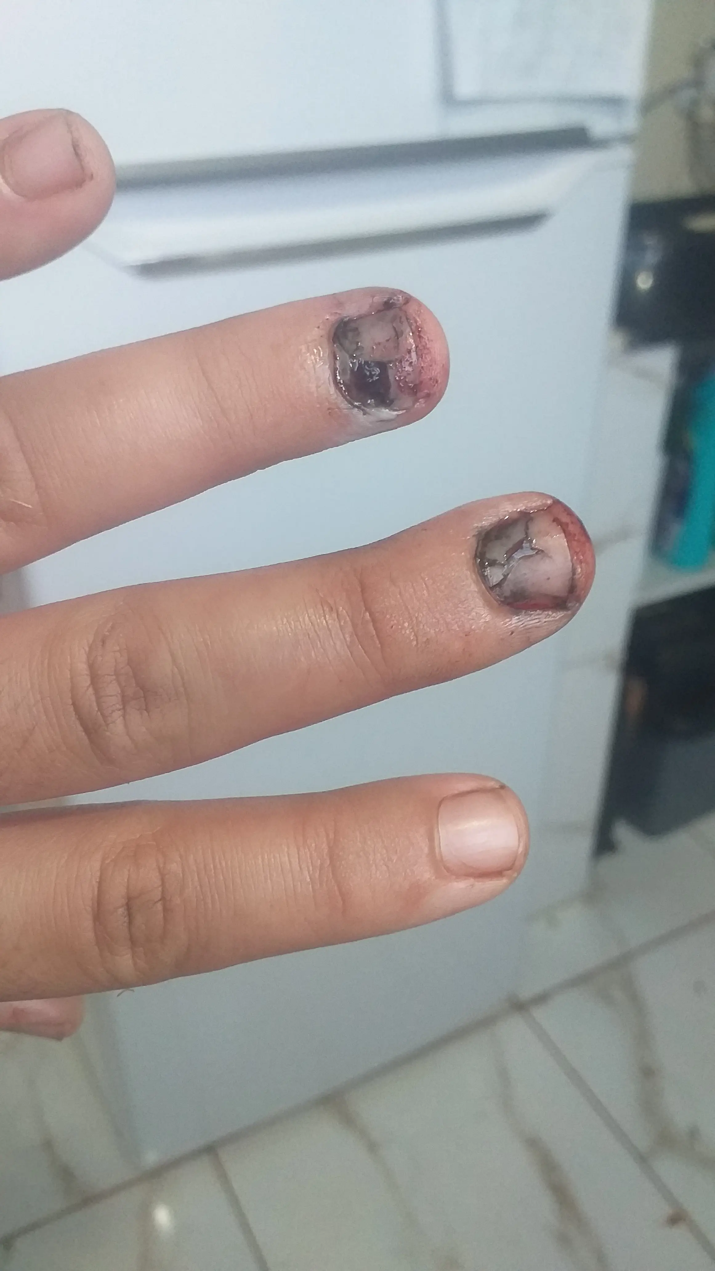 Danos nos dedos causados por coroa de moto